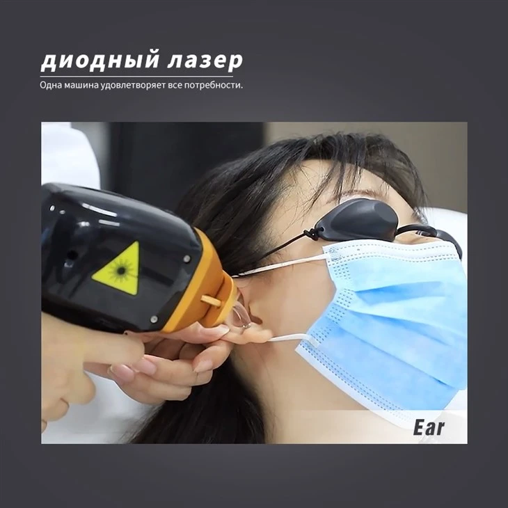 диодное лазерное удаление волос
