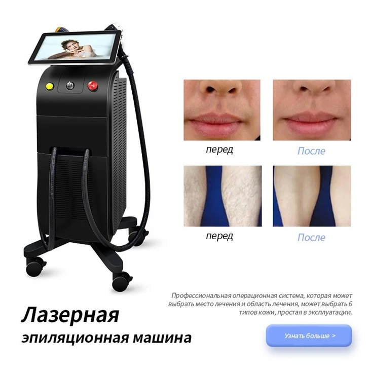 диодное лазерное удаление волос